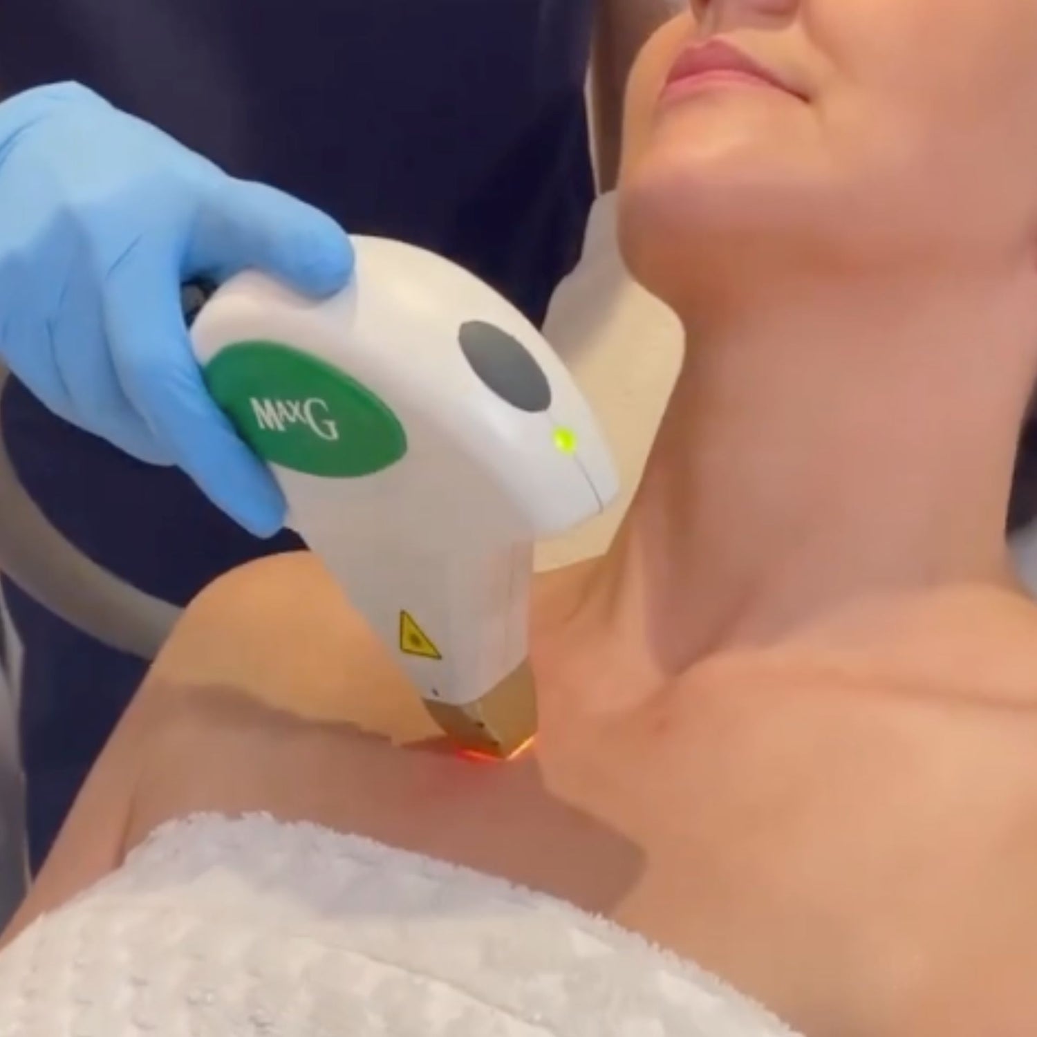 Before After IPL Photofacial to remove pigmentation at Medicetics, Central London