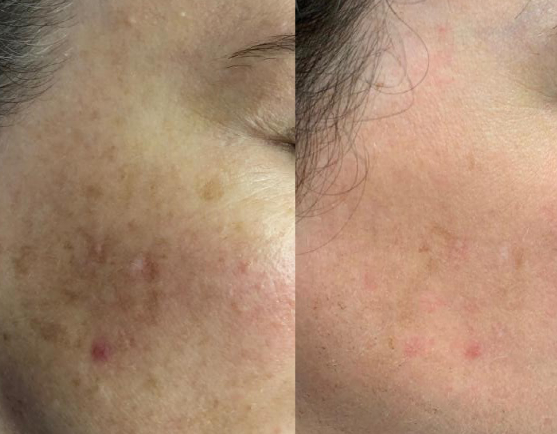 Before After IPL Photofacial to remove pigmentation at Medicetics, Central London