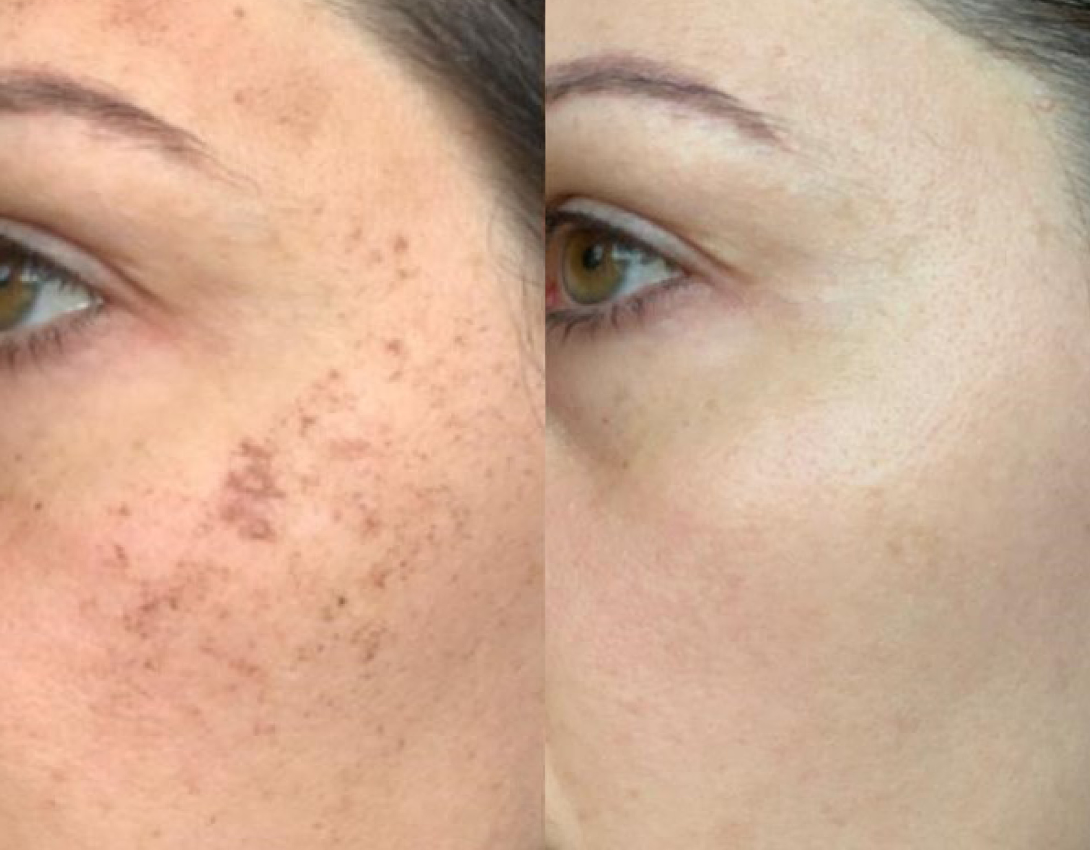 Before After IPL Photofacial to remove pigmentation at Medicetics, Central London