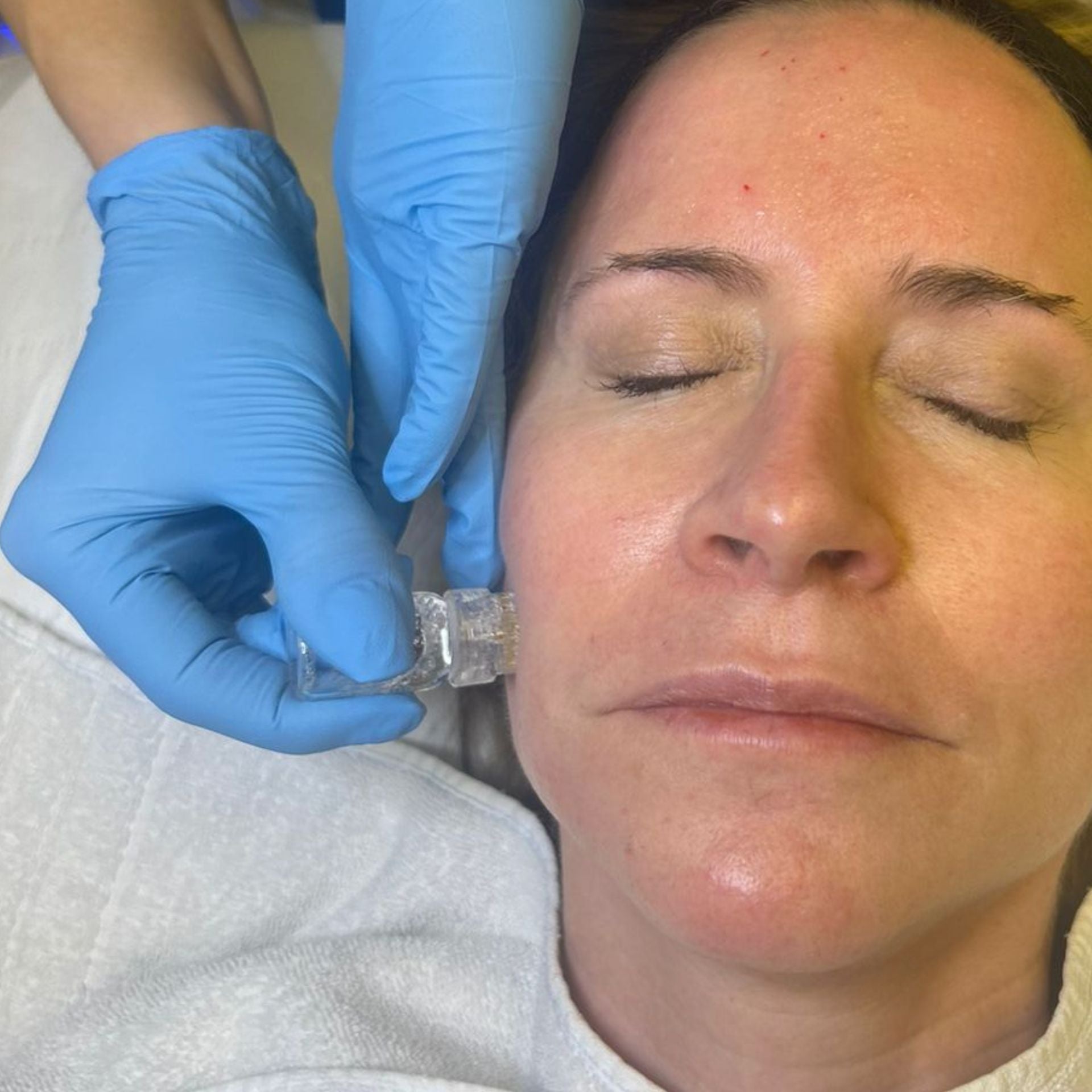 Aquagold Fine Touch Facial, also known as the ‘Gold Microinfusion facial’ or the ‘Glass Skin Facial’, at Medicetics London