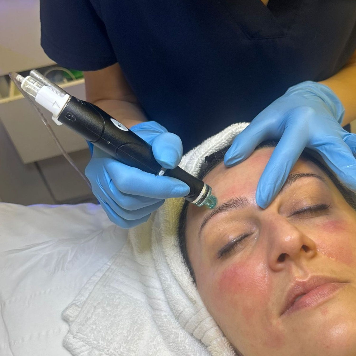 Hydrafacial expert facials at Medicetics London