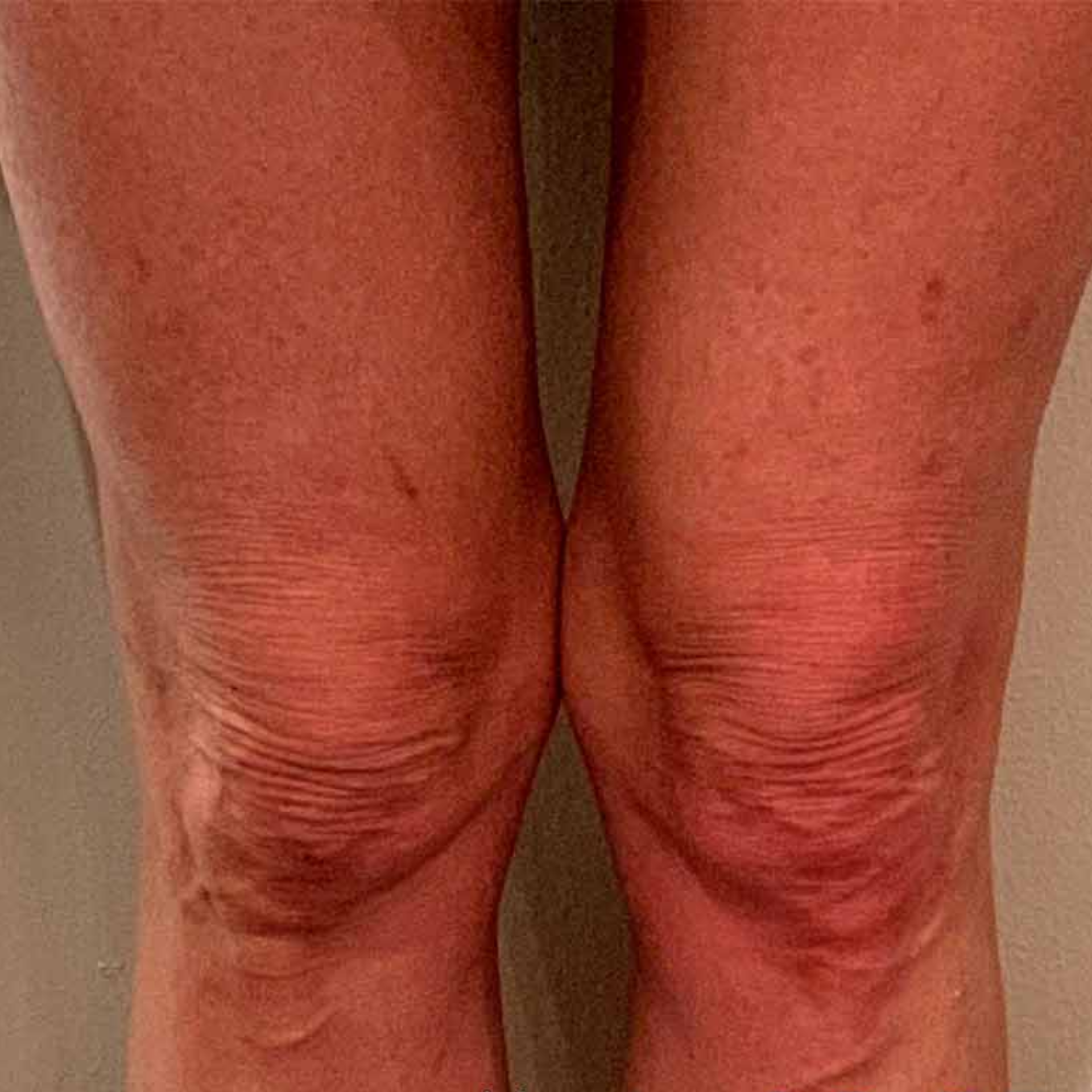 After Morpheus8 Body to help firm skin on thighs and knees. Treatment at Medicetics London