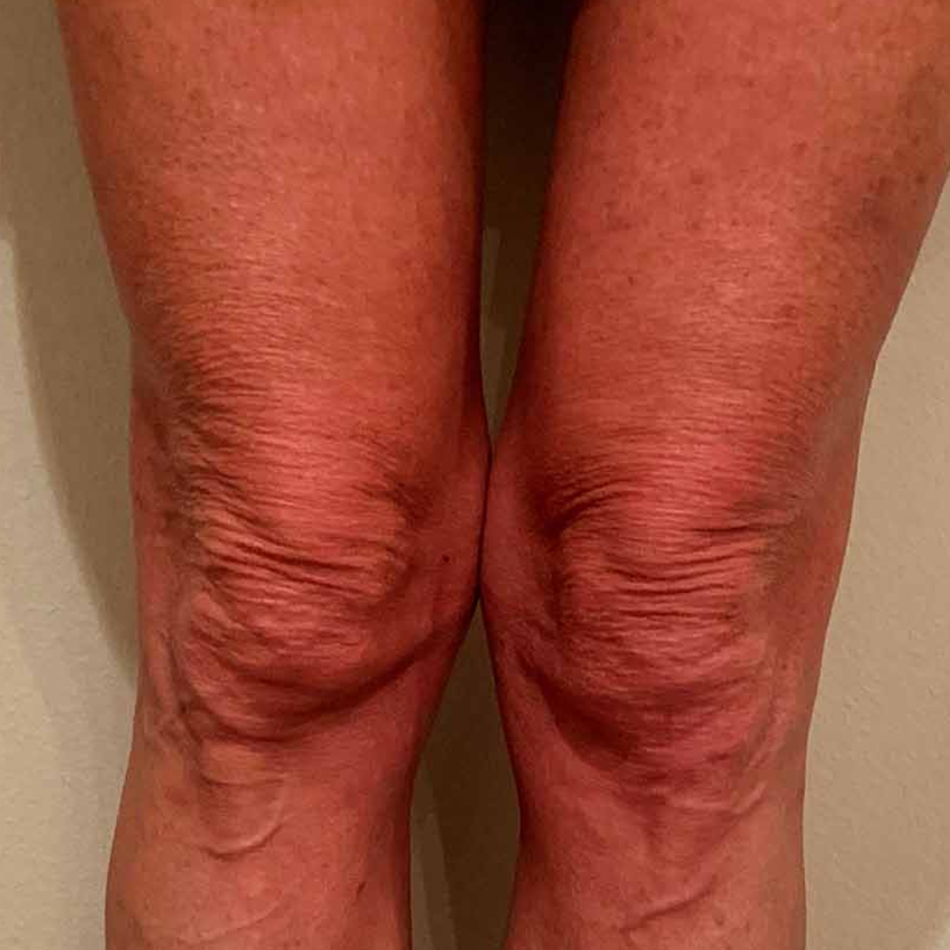 Before Morpheus8 Body to help firm skin on thighs and knees