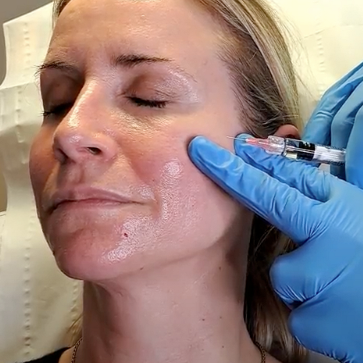 Advanced Profhilo Skin Booster treatment to boost hydration and restore firmness at Medicetics London