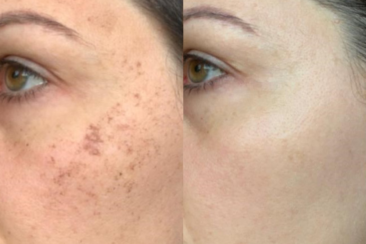 IPL for facial pigmentation