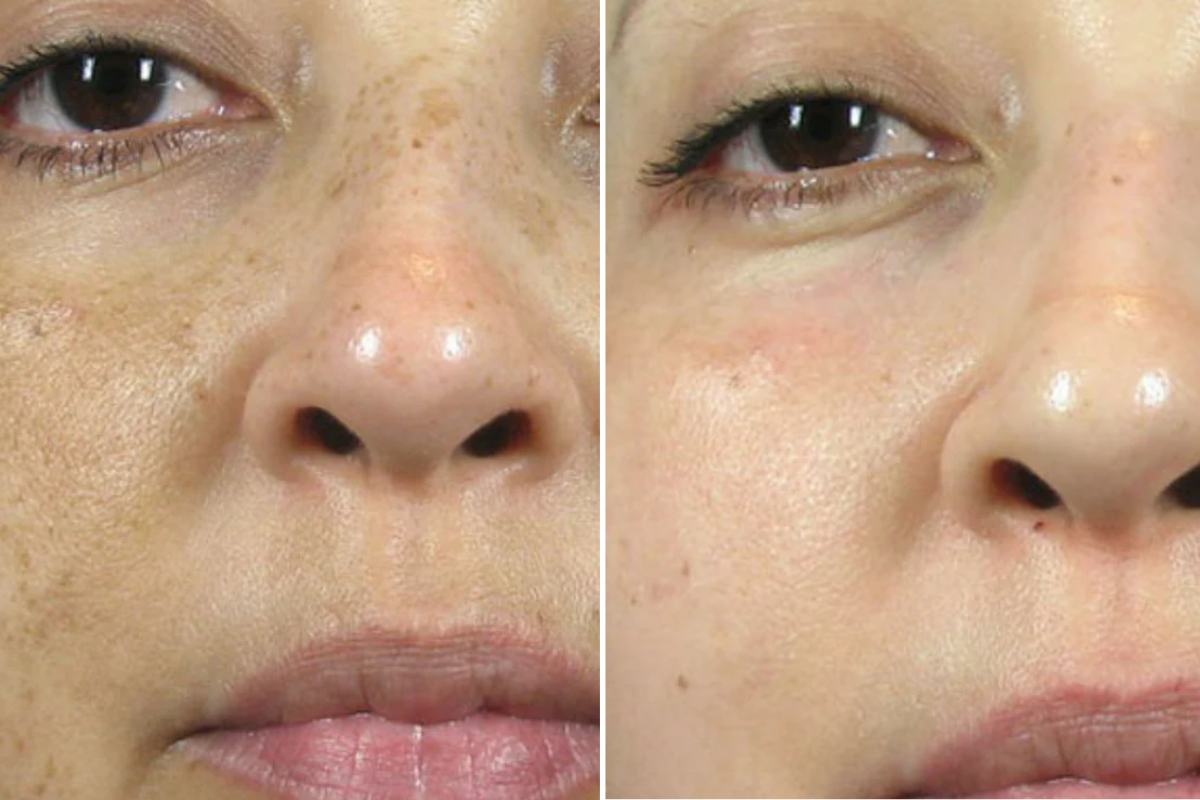 Before After Obagi Nuderm Treatment for Pigmentation
