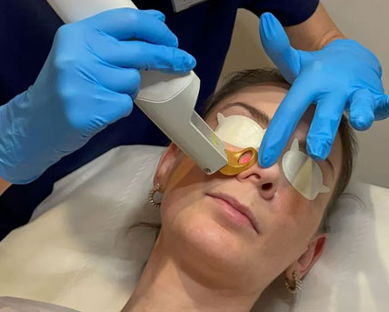 excel v laser treatment for redness at Medicetics, London