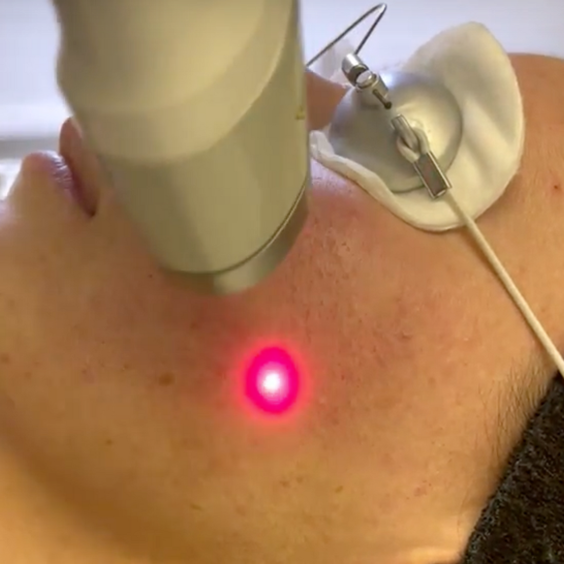 Laser Genesis Facial in Central London – Medicetics