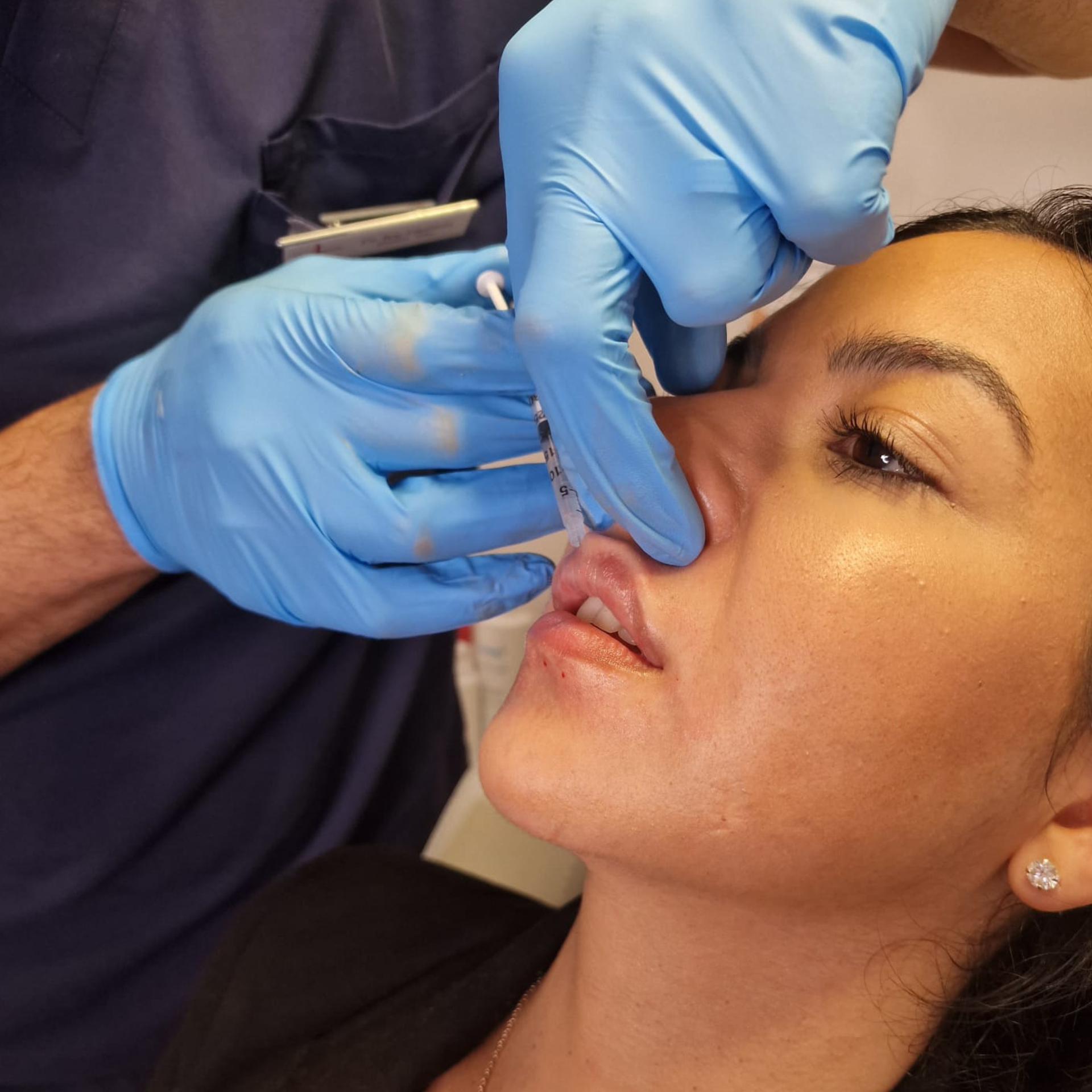 dr Vy injects hyaluronic acid lip fillers into a clients lips for a fuller lip at Medicetics, London.