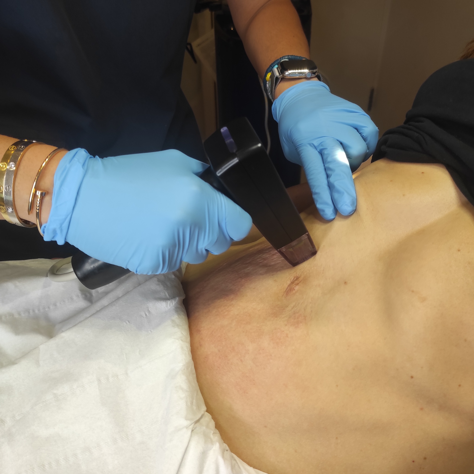 Dr Sepi treats a patient with Morpheus 8 Body to tighten sagging skin on their belly. Treatment is at Medicetics, Central London. 