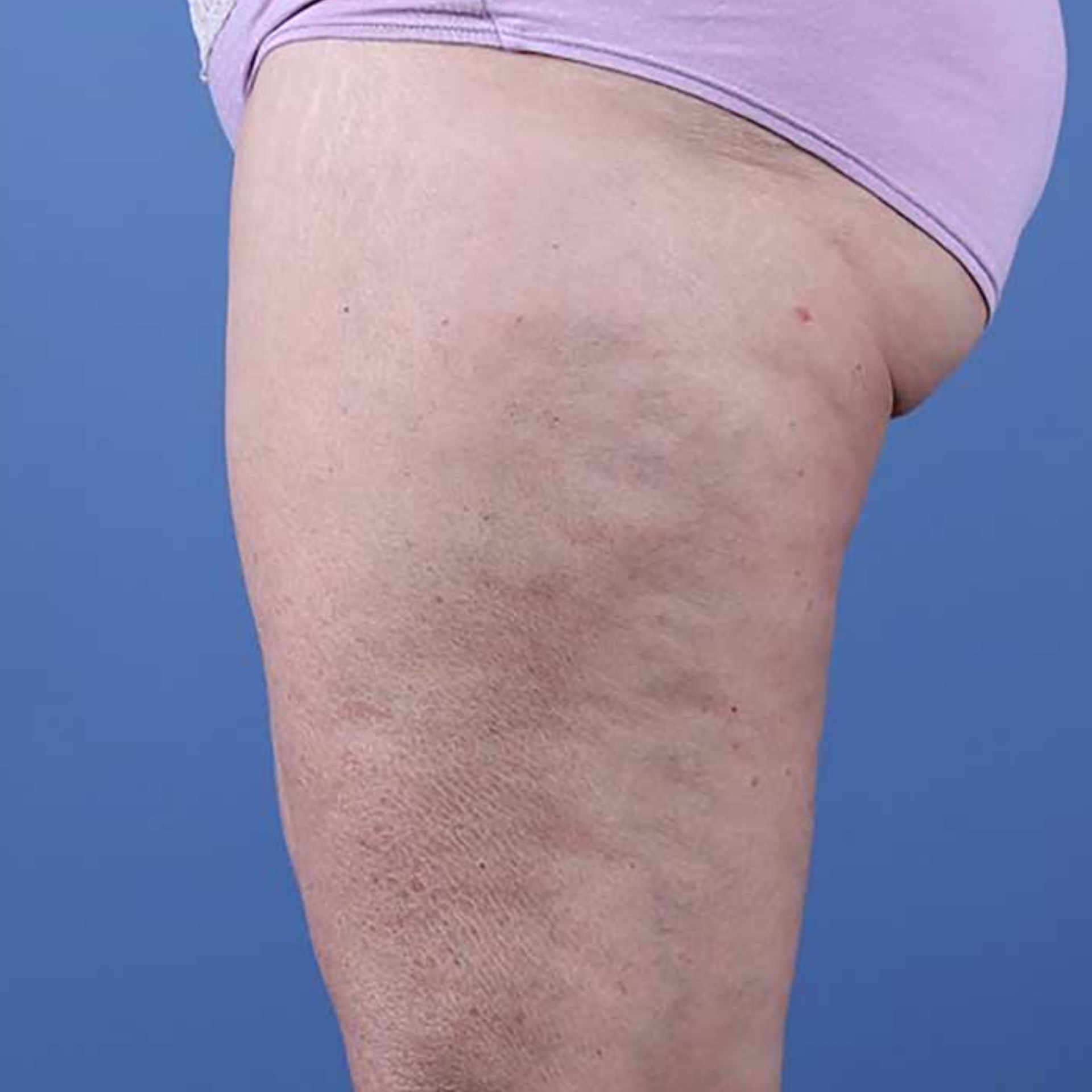 Before Morpheus8 Body to help reduce cellulite and firm skin on buttocks and thighs