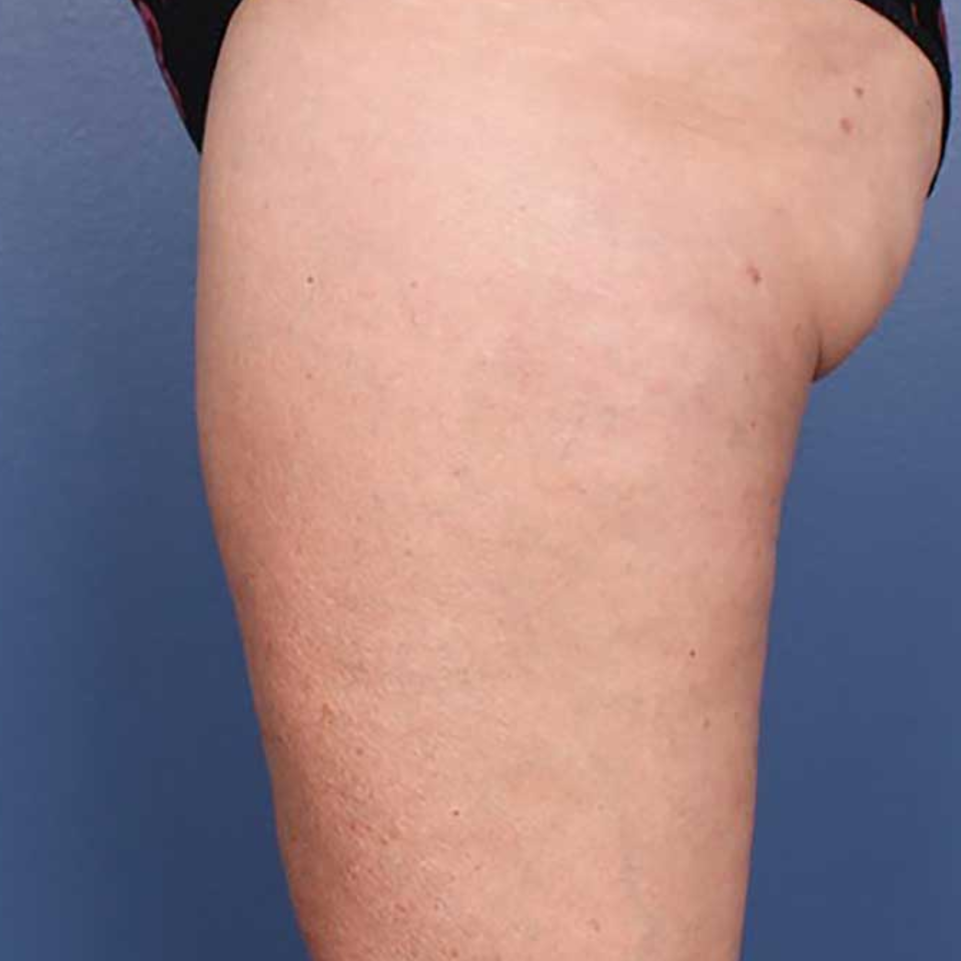 After Morpheus8 Body to help reduce cellulite and firm skin on buttocks and thighs