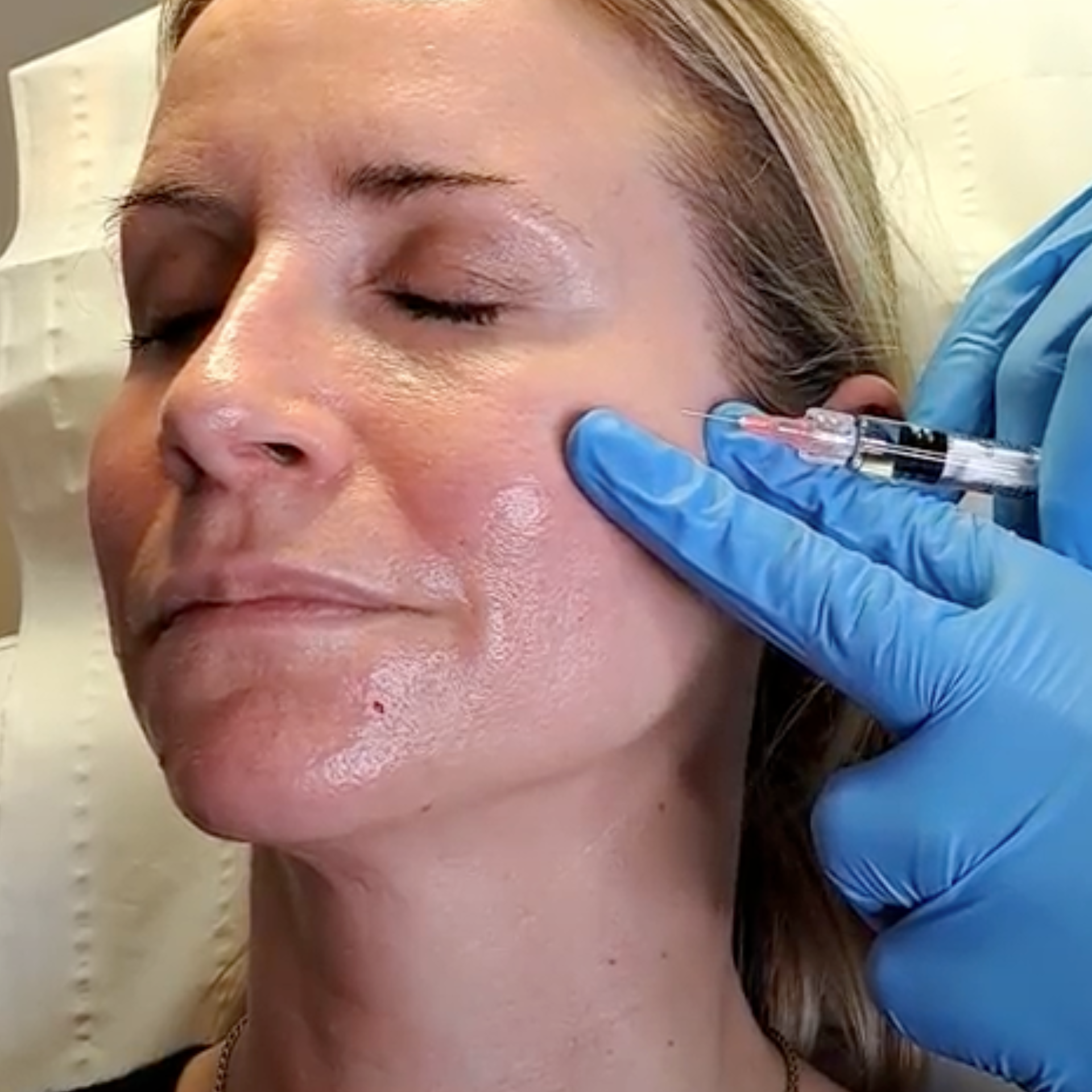 Advanced Profhilo Skin Booster treatment to boost hydration and restore firmness at Medicetics London